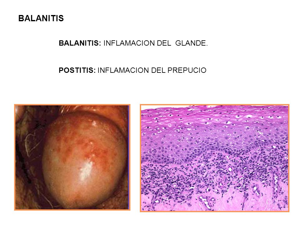 La psoriasis pustular el herpes